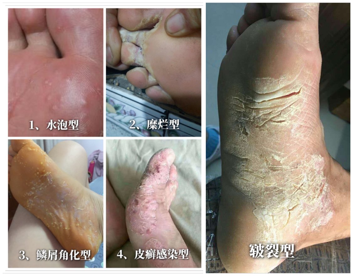 脚气类型